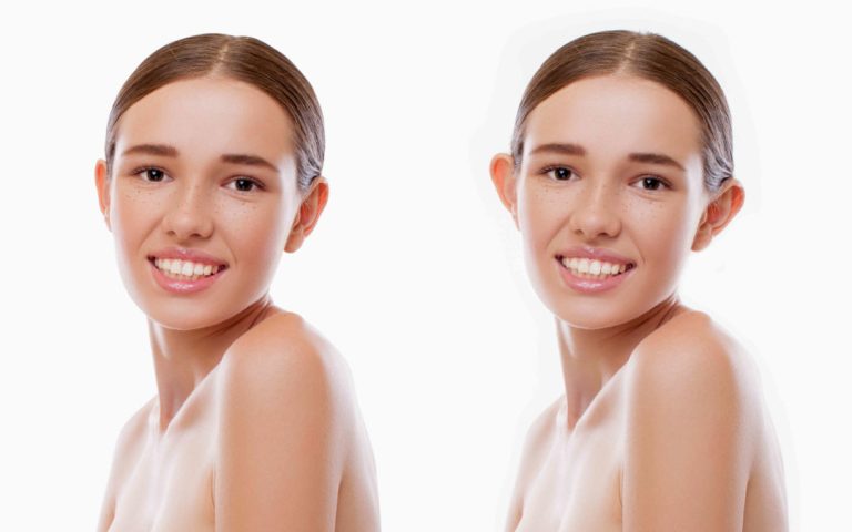 Ωτοπλαστική – Αποκαταστήστε το σχήμα των αυτιών με φυσικότητα και διακριτικότητα Ωτοπλαστική – Αποκαταστήστε το σχήμα των αυτιών με φυσικότητα και διακριτικότητα